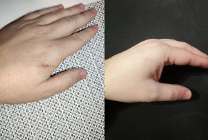 Dermamel ženski recenziraj prije i poslije ožiljci od akni i akne